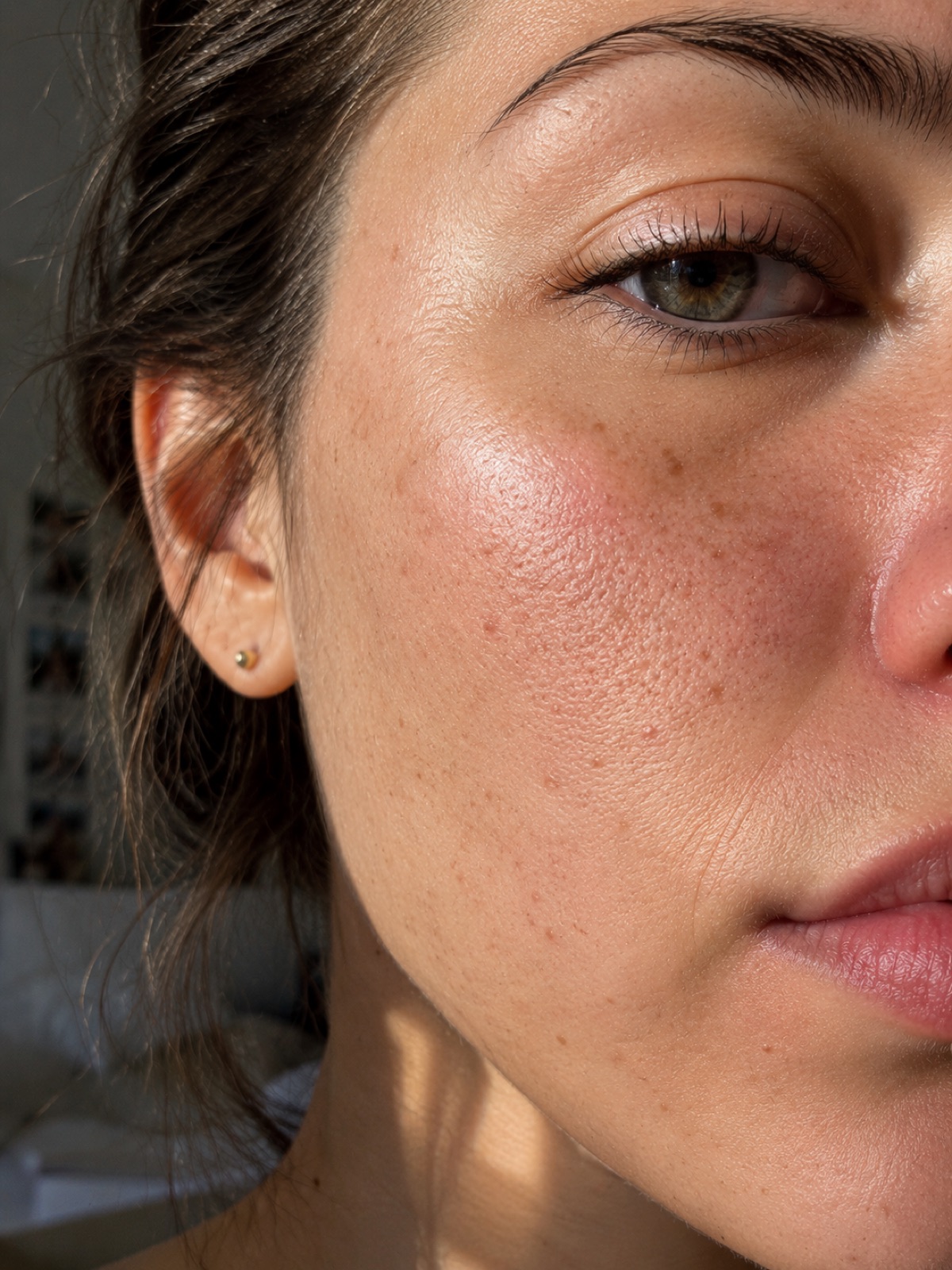 Close-up of a cheek showing redness and visible pores